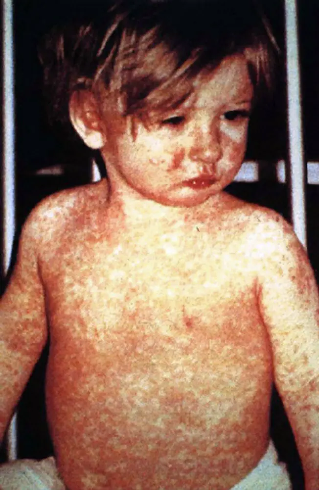 The Rising Significance of Measles Vaccination in Canada image 1