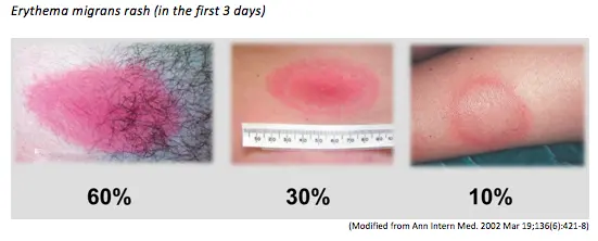 Understanding Lyme Disease: Risks, Symptoms, and Prevention