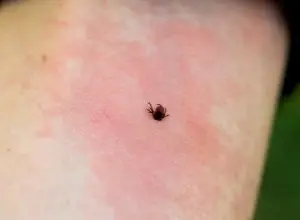 L’Augmentation de la Maladie de Lyme au Canada