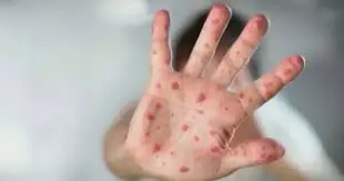 Measles Cases on the Rise in Ottawa: What You Need to Know