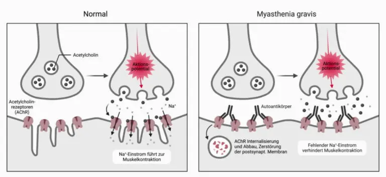 What You Need to Know About Myasthenia Gravis image 1