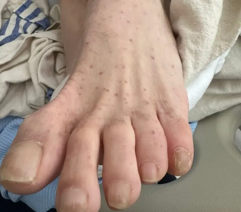 Understanding Rocky Mountain Spotted Fever and Its Risks image 1