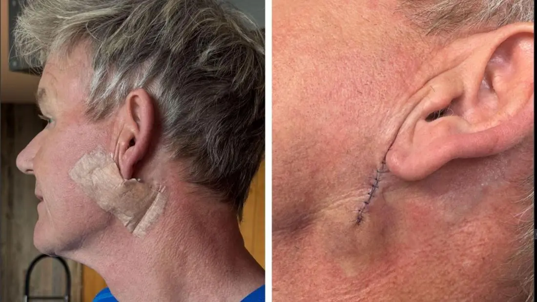 Gordon Ramsay et son combat contre le cancer de la peau image 1