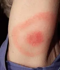 La montée préoccupante de la maladie de Lyme au Canada image 1