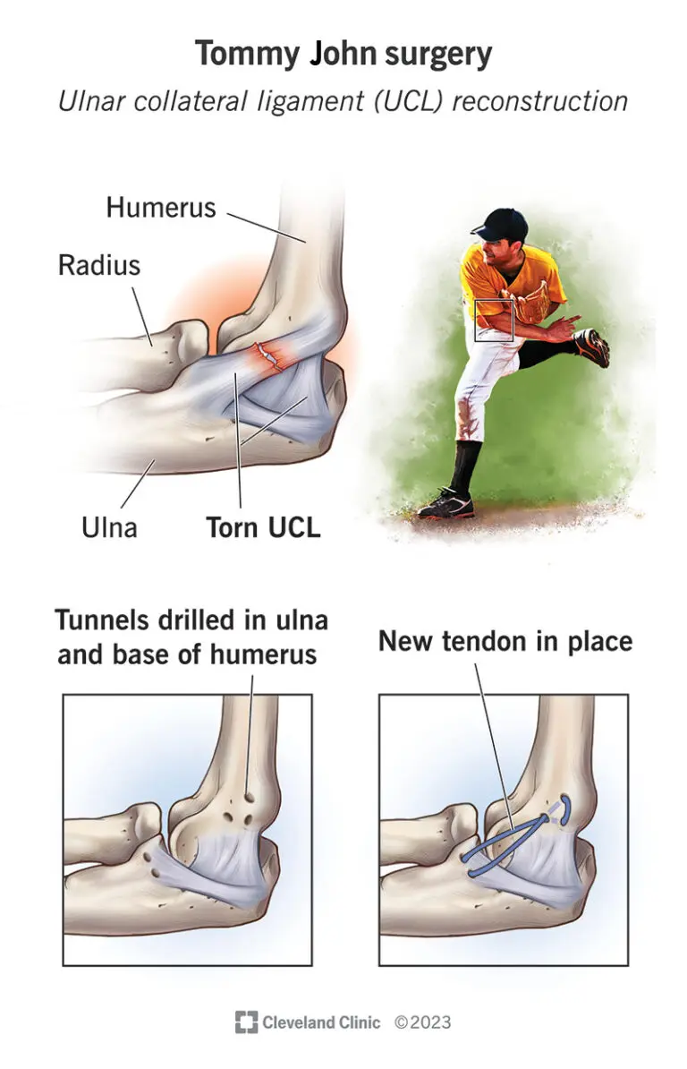 Understanding Tommy John Surgery: Key Insights and Facts
