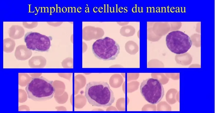 Qu’est-ce que le Lymphome du Manteau ?