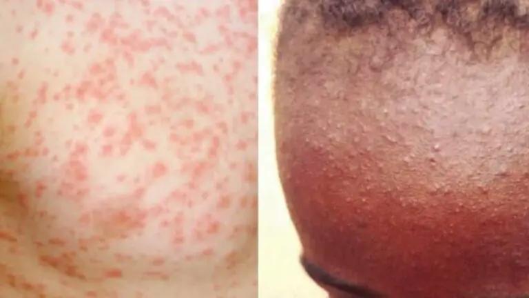 Understanding the Current Measles Outbreaks in Canada image 1