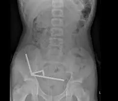 The Dangers of Swallowing Magnets: What You Need to Know