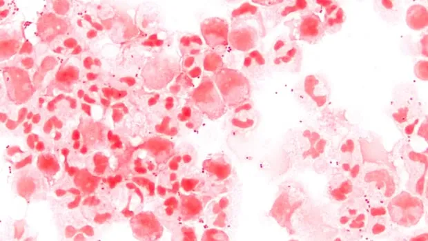 dangerous bacterial infection in canada — CA news